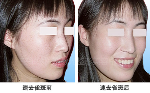 光子嫩肤美白 赶走肤色暗沉